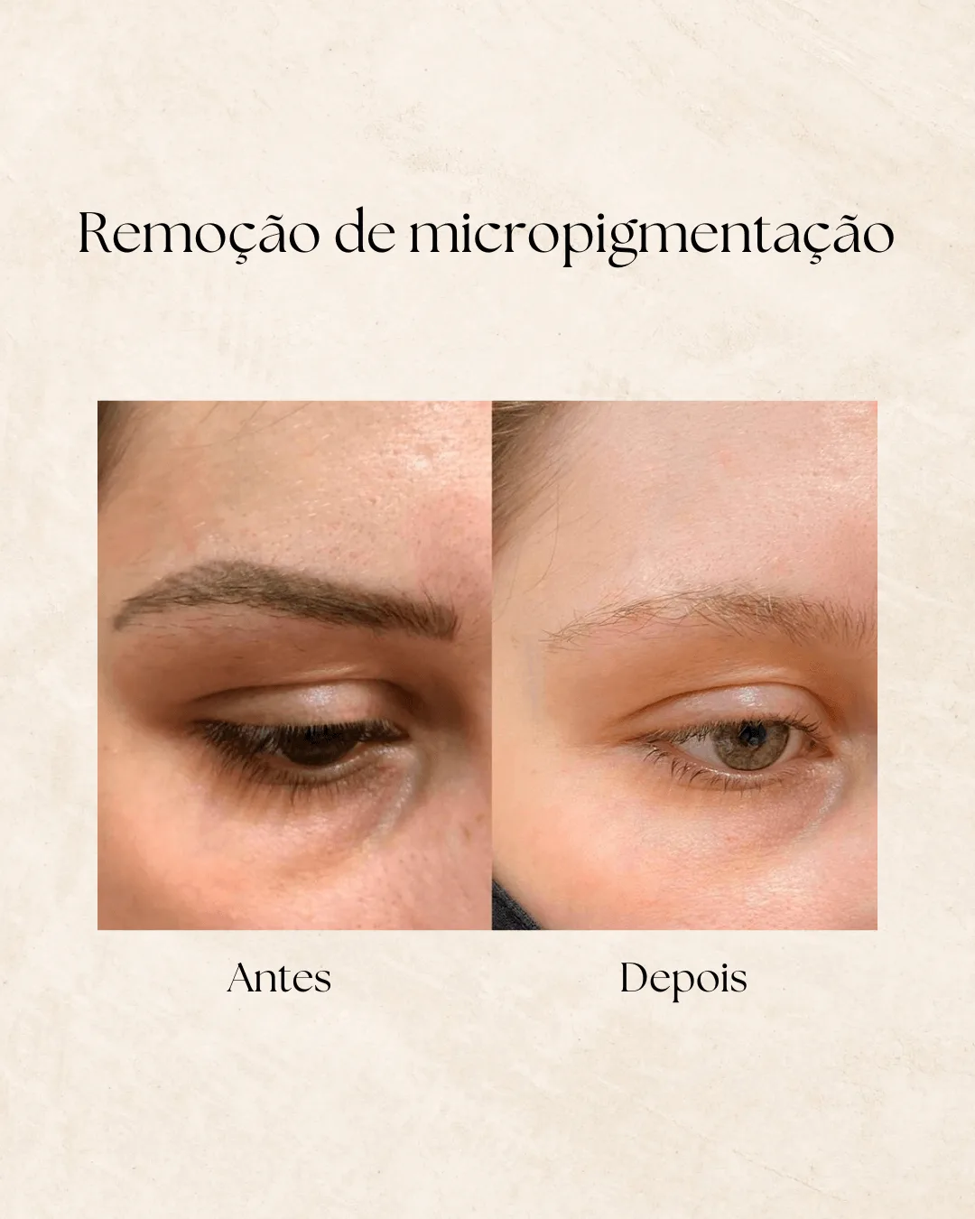 Remoção de tatuagem — antes e depois 4
