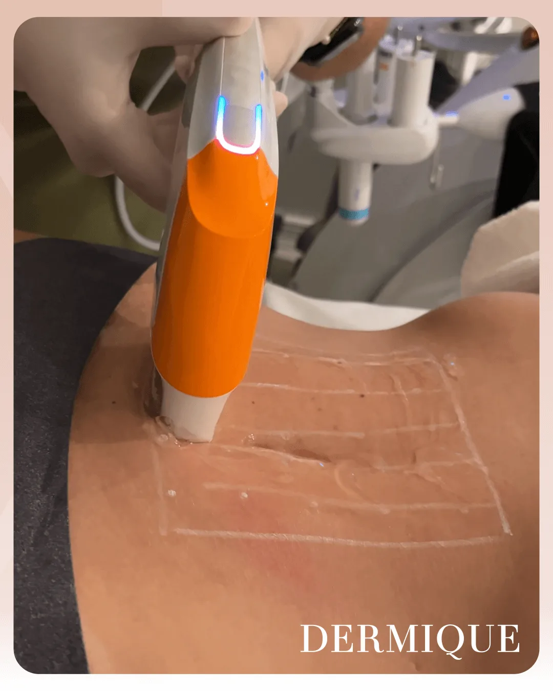 Ponteira Ultra Booster do Ultraformer MPT na Clínica Dermique