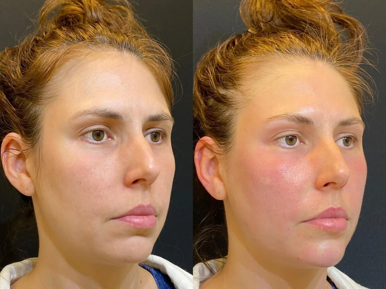Antes e depois de tratamento com laser Fotona na Clínica Dermique
