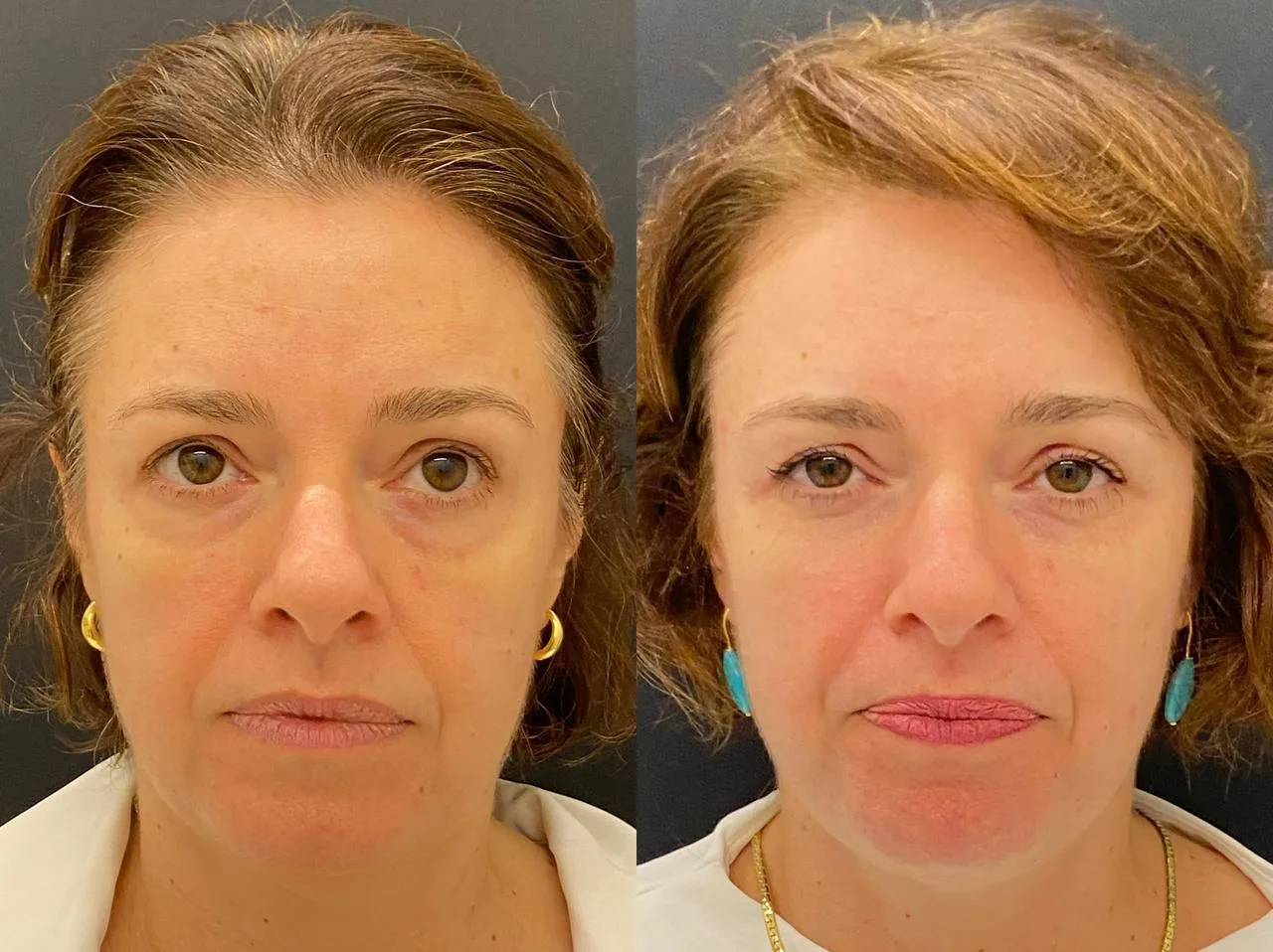 Antes e depois de tratamento com laser Fotona na Clínica Dermique