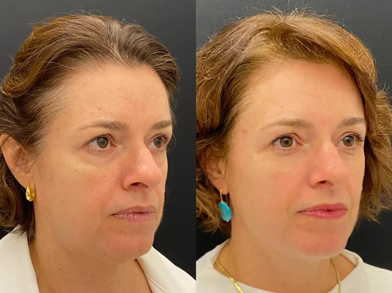 Antes e depois de tratamento com laser Fotona na Clínica Dermique