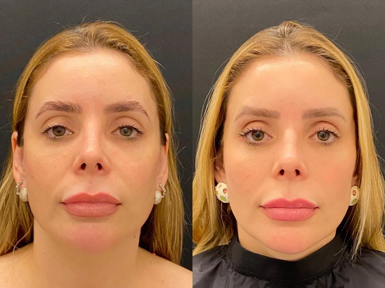 Antes e depois de tratamento com laser Fotona na Clínica Dermique
