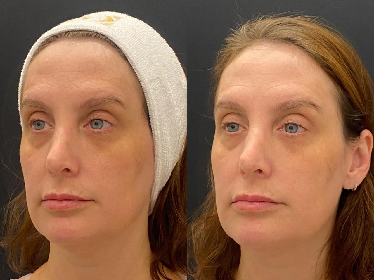 Antes e depois de tratamento com laser Fotona na Clínica Dermique