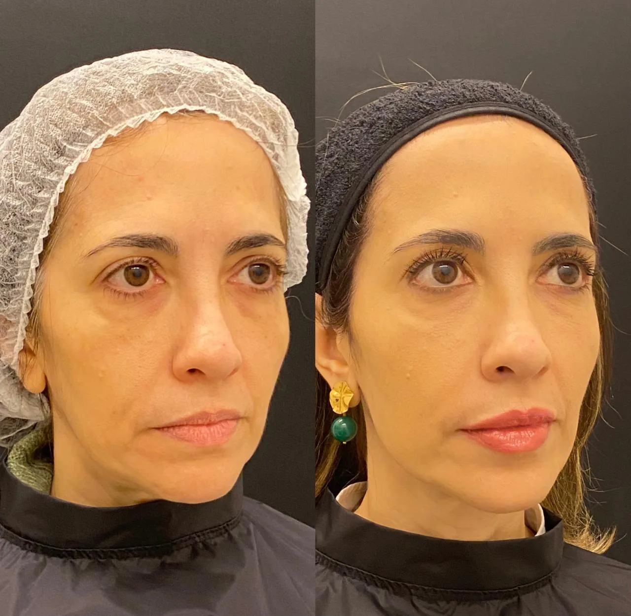 Antes e depois de rejuvenescimento facial com laser Fotona na Clínica Dermique