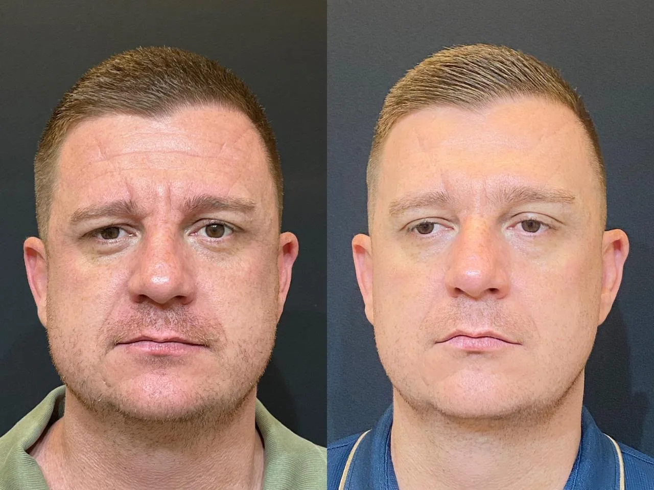 Antes e depois de tratamento com laser Fotona na Clínica Dermique
