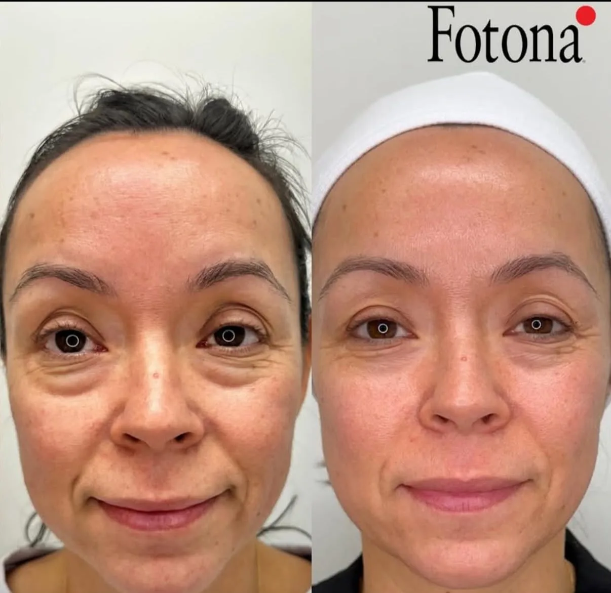 Antes e depois de tratamento com laser Fotona na Clínica Dermique