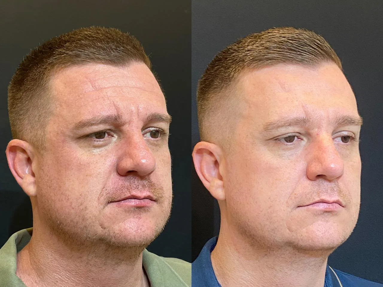 Antes e depois de tratamento com laser Fotona na Clínica Dermique