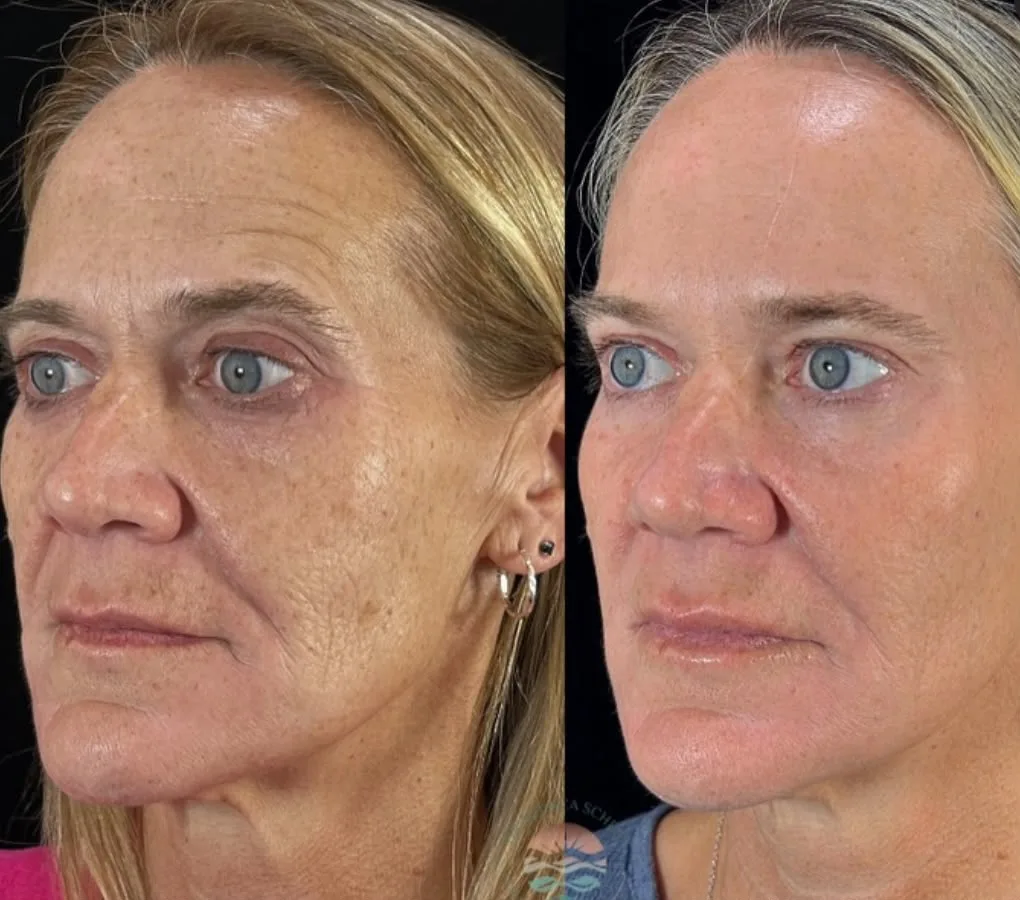 Antes e depois de laser de CO2 fracionado: rugas finas, manchas e textura do rosto em vista lateral