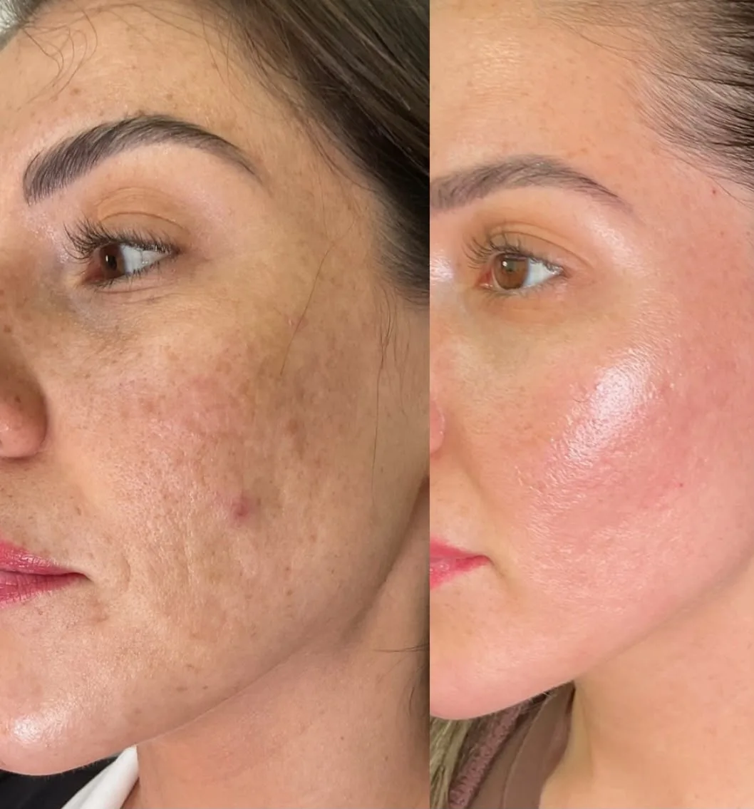 Antes e depois de laser de CO2 fracionado: manchas e textura irregular na bochecha