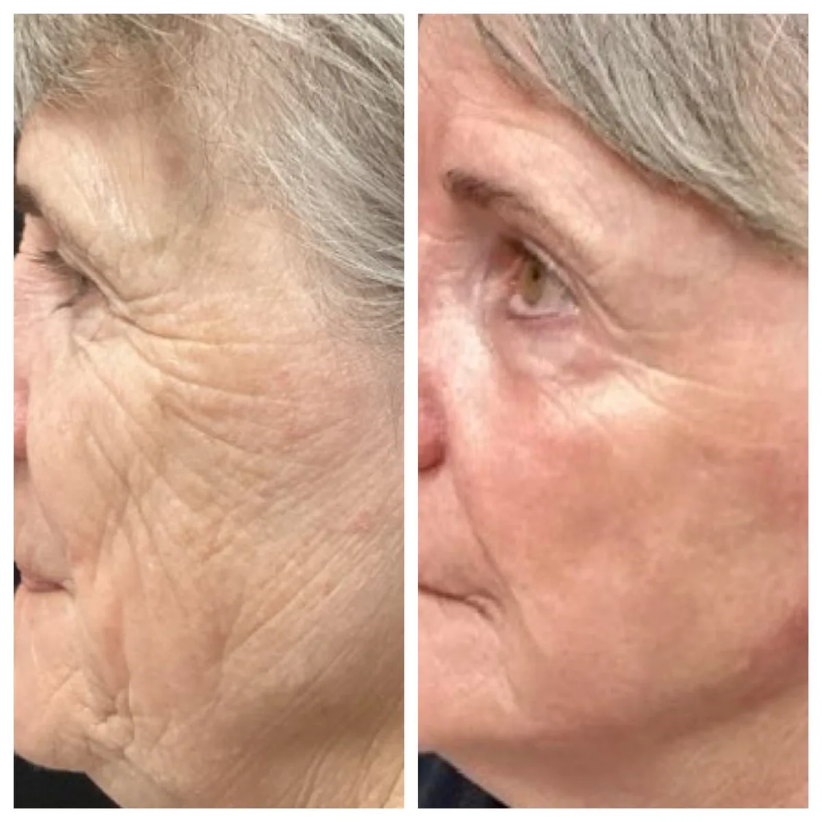 Antes e depois de laser de CO2 fracionado: rugas profundas na lateral do rosto