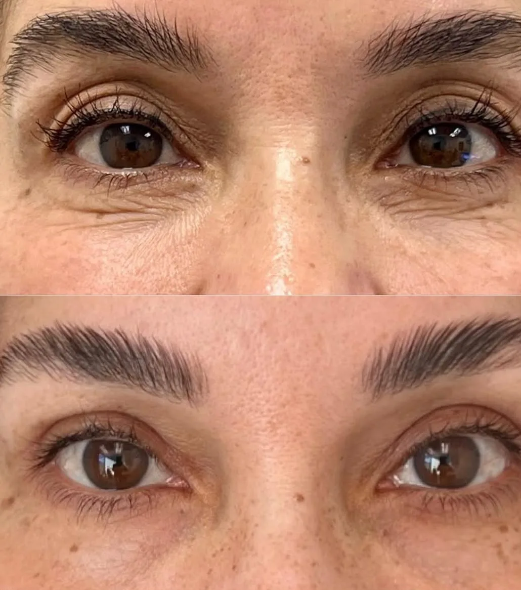 Antes e depois de laser de CO2 fracionado: linhas finas na região dos olhos, antes em cima e depois embaixo